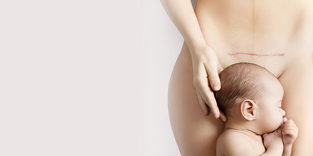 Woman showing her caesarean section scar